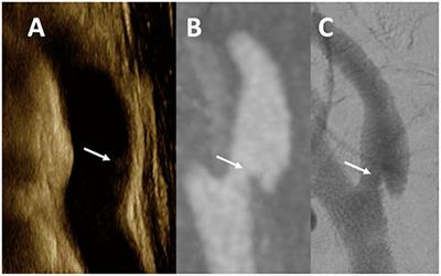 Multimodality Imaging in Carotid Web